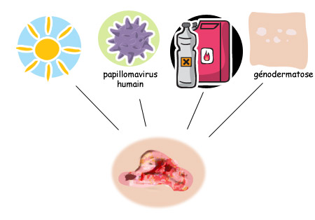 causes des cancers cutanés