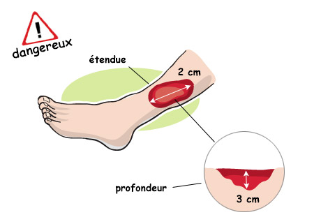 évolution de la tumeur