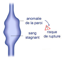 schéma varice, veines