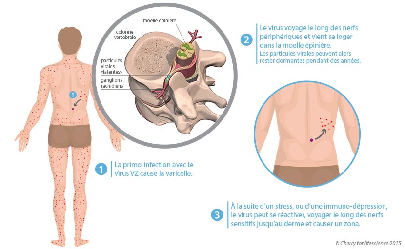 varicelle et zona