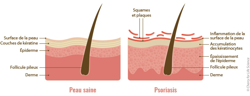 schéma peau saine et psoriasis