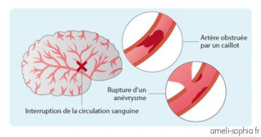 AVC comment réagir infographie améli-sophia