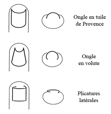 ongle incarné infographie