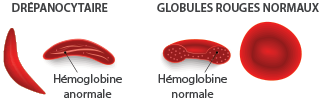 anémie : globules rouges