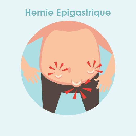 hernie epigastrique