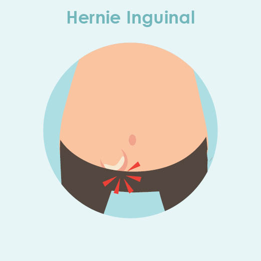 hernie inguinal