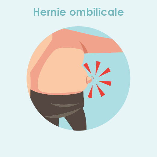 hernie ombilicale