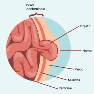 schema hernie