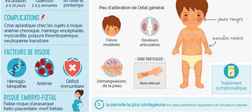 Infographie : érythème infectieux ou mégalérythème ou la 5ème maladie