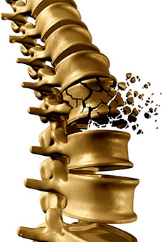 Rupture de la colonne vertébrale