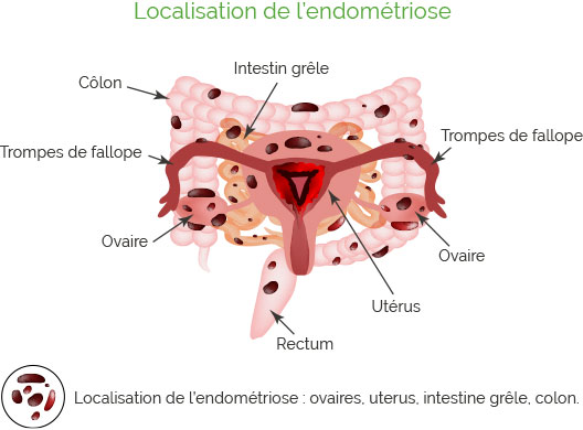 schema-endometriose