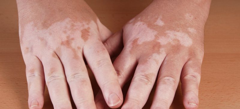 vitiligo phototherapie