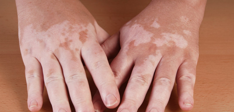 vitiligo phototherapie