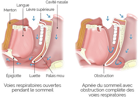 Mecanisme-apnee-du-sommeil