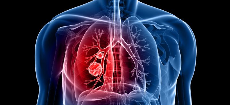 cancer bronchique test sanguin