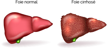 foie normal et d'un foie cirrhosé