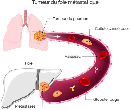 tumeur de foie métastatique