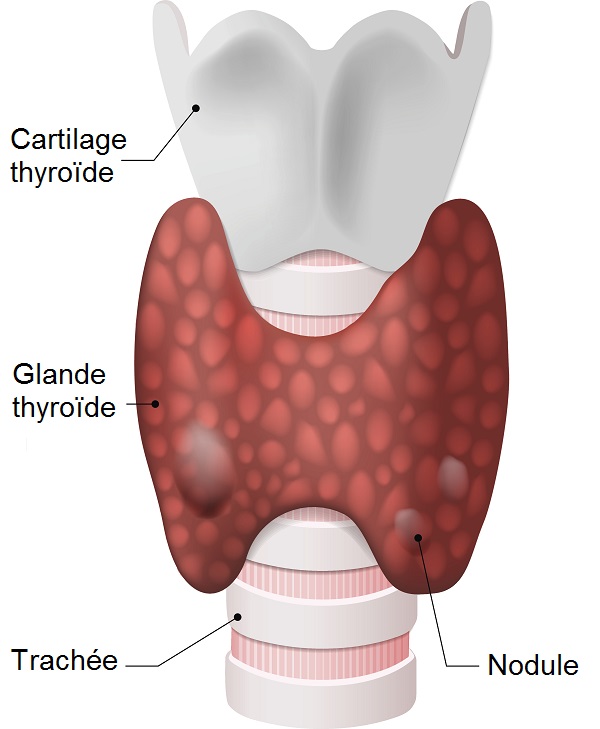 Nodule-thyroide