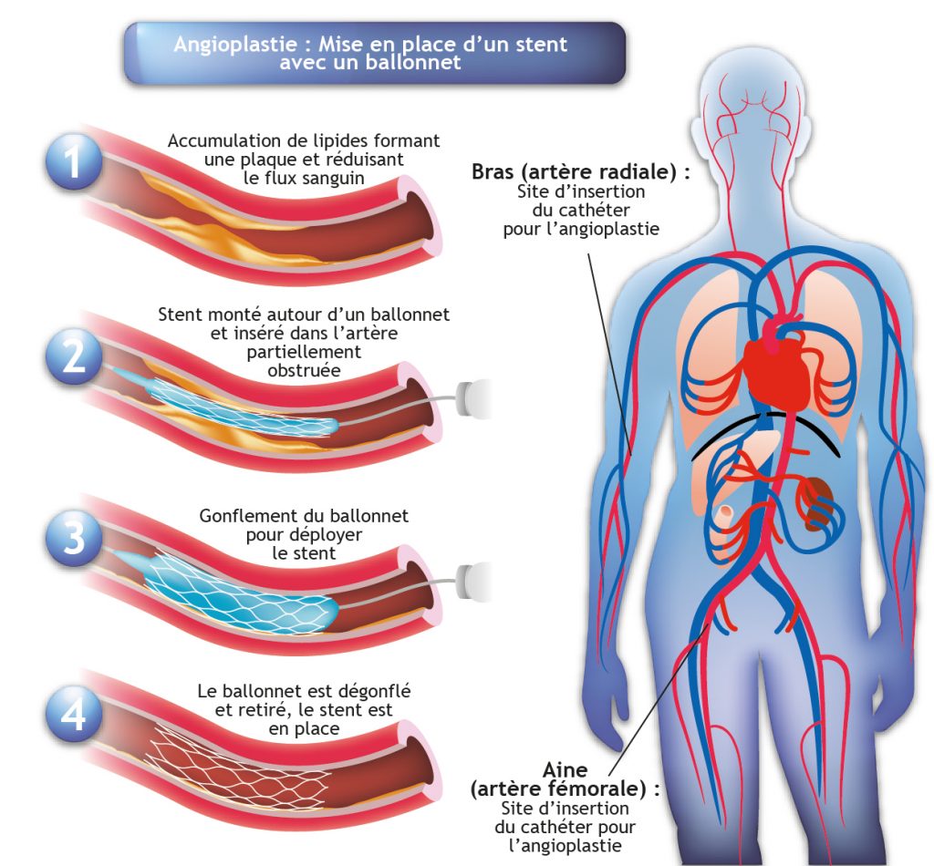 Schéma explicatif de l'angioplastie