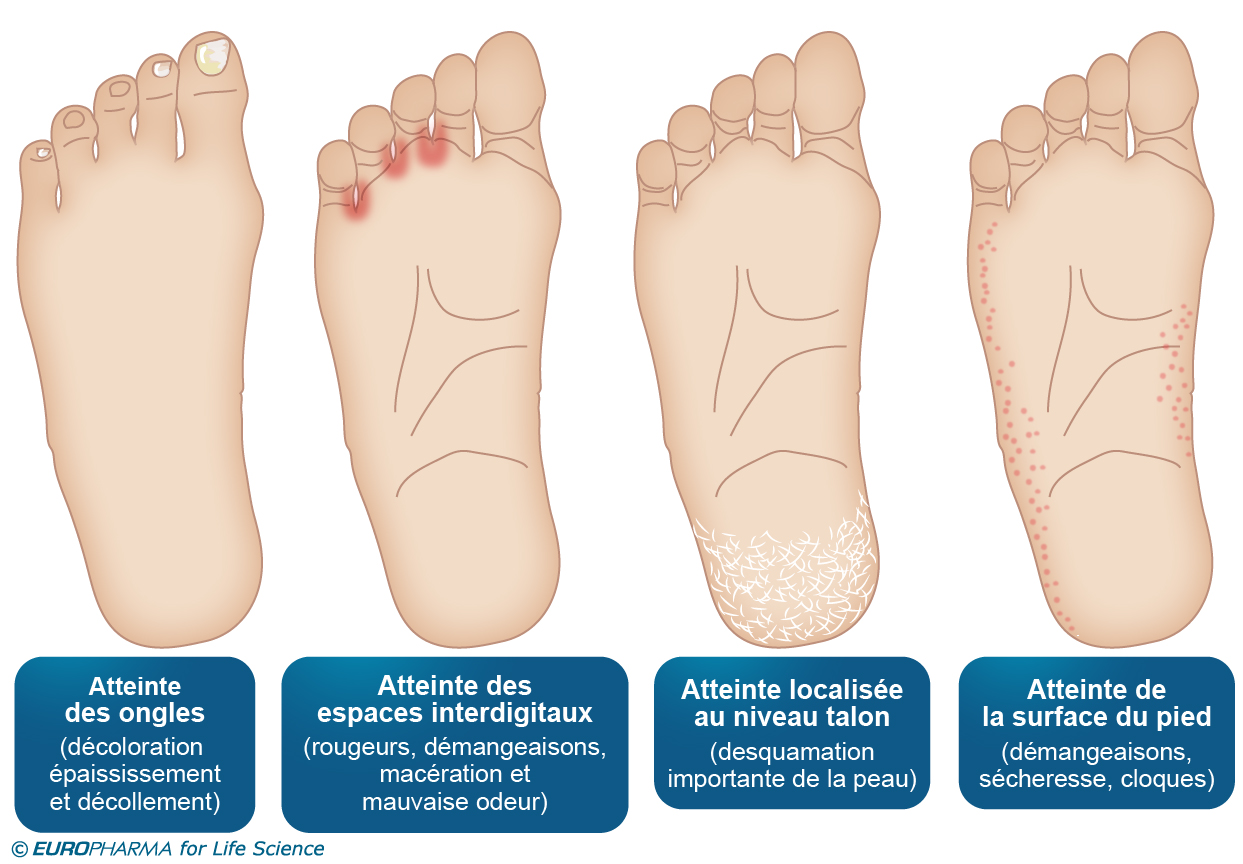 mycoses des pieds