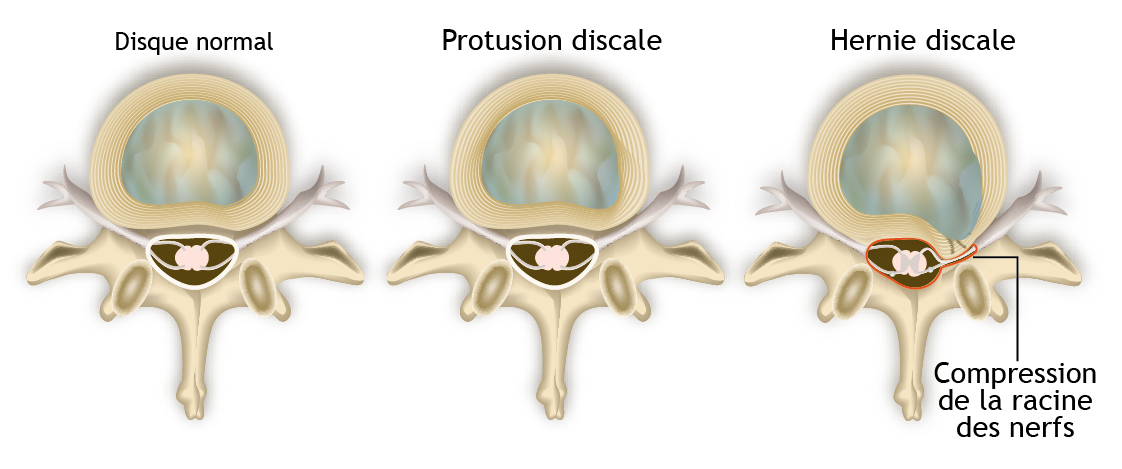 Progression de l'installation de la hernie discale