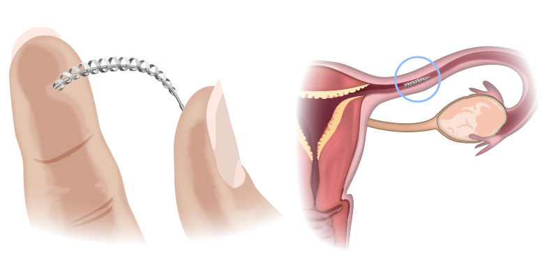 implant essure