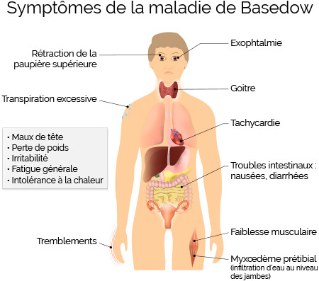 Symptômes de la maladie de Basedow