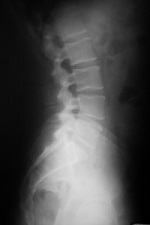 radiographie pour voir une hernie discale