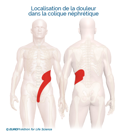 douleur-colique-nephretique