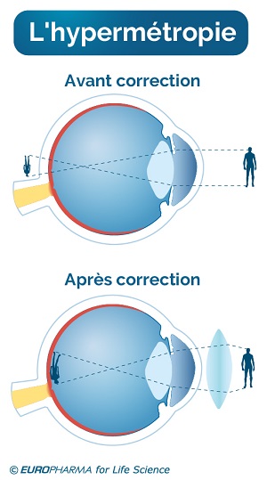 hypermetropie correction