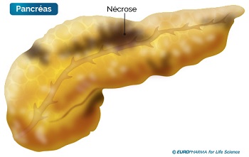 necrose-pancreas