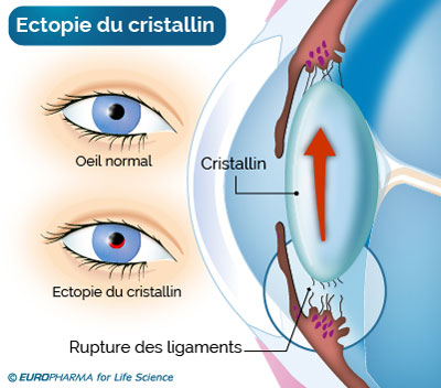 rupture Cristallin