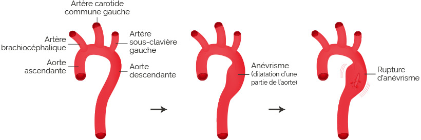 rupture anevrisme aortique