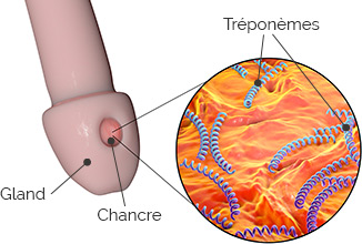 chancre-syphilitique