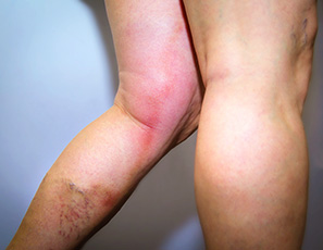 Thrombophlébite de jambe - phlébite