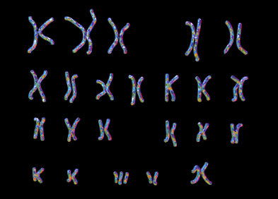 autres trisomies