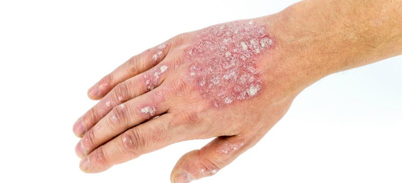 lien entre obésité et psoriasis