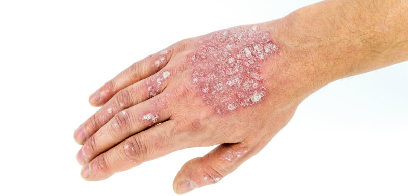 lien entre obésité et psoriasis