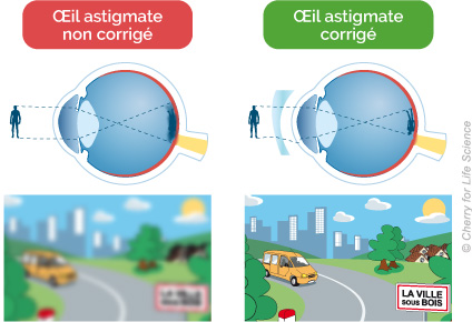 shema astigmate vision floue et vison corrigée nette 