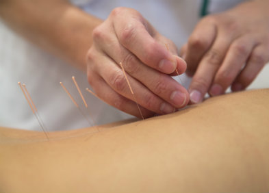 Acupuncture