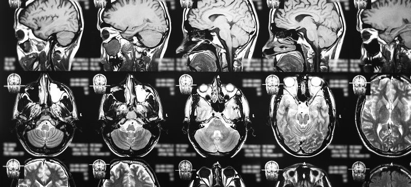 Des images de résonance magnétique des maladies neurodégénératives