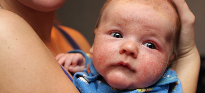 Un nourrison présentant des allergies cutanées