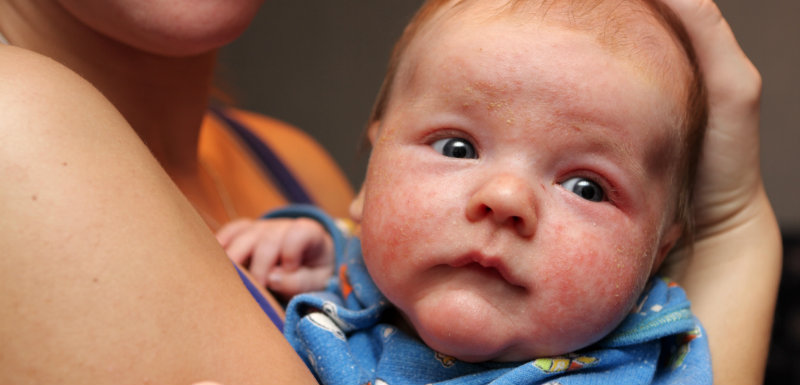 Un nourrison présentant des allergies cutanées