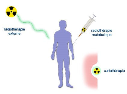 types radiothérapie