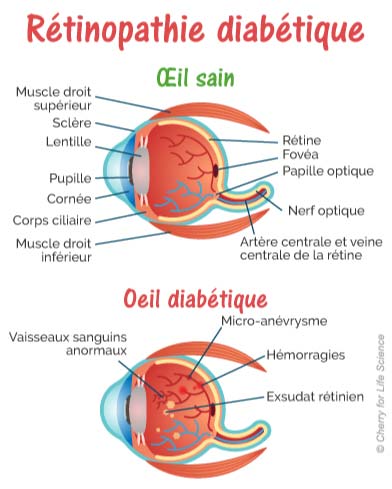 retinopathie-diabetique