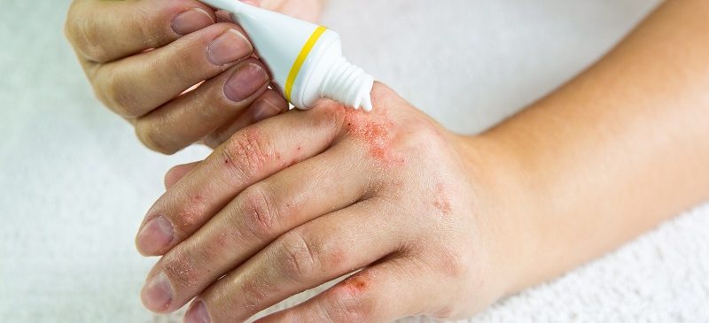 Eczema