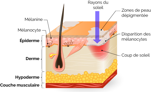 coupdesoleil