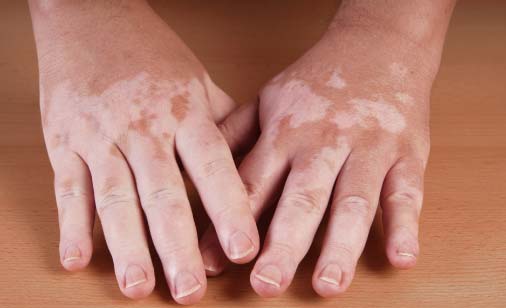 main_vitiligo