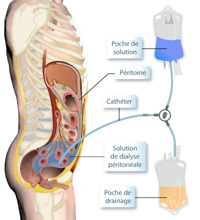 Schéma de dialyse péritonéale