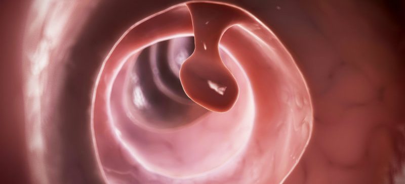 polype, l'intelligence artificielle détecte le cancer colorectal